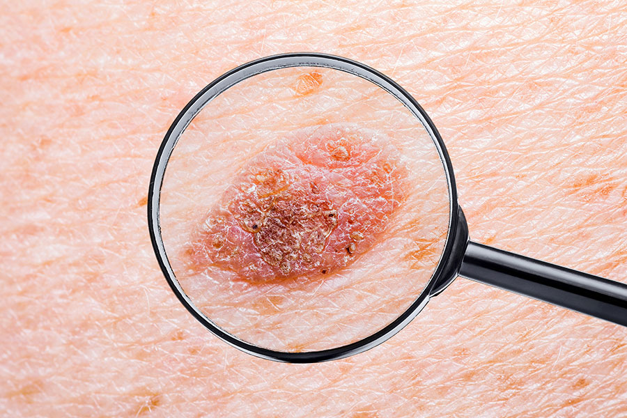 prueba-deteccion-lunares-pecas-control-dermatologo-revisar-melanoma-cancer-de-piel-dermatologia-dermatologo-dr-lopez-gil-clinica-teknon-barcelona-